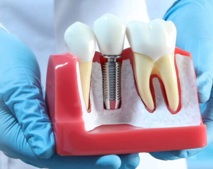 dentist hold dental implants structure