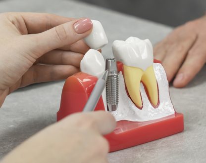 dentist explaining dental implant procedure