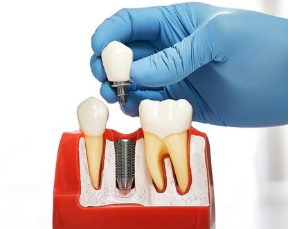 Dental Implants: Safe, Effective, and Life-Changing
