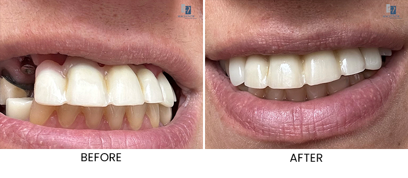 Dental implant before and after