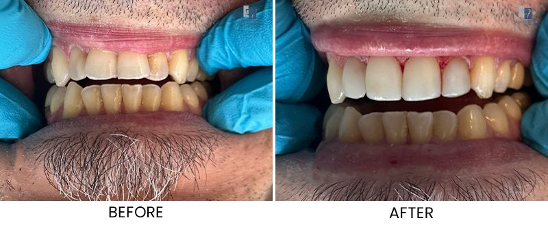 Composite veneers before and after