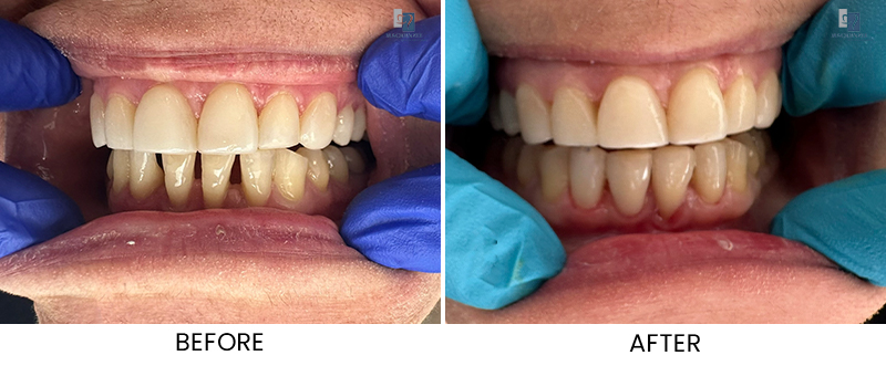 Composite veneers before and after