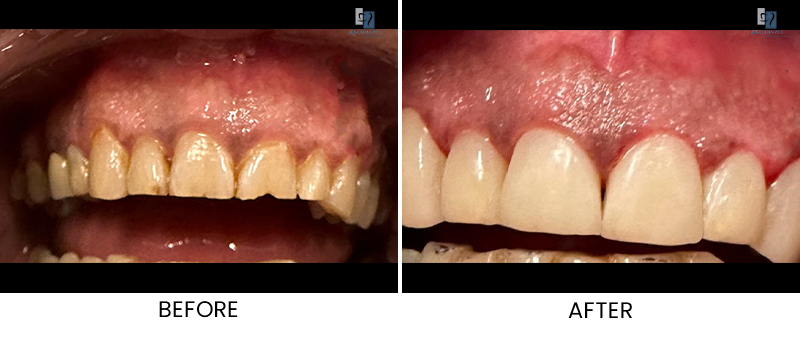 Composite veneers before and after