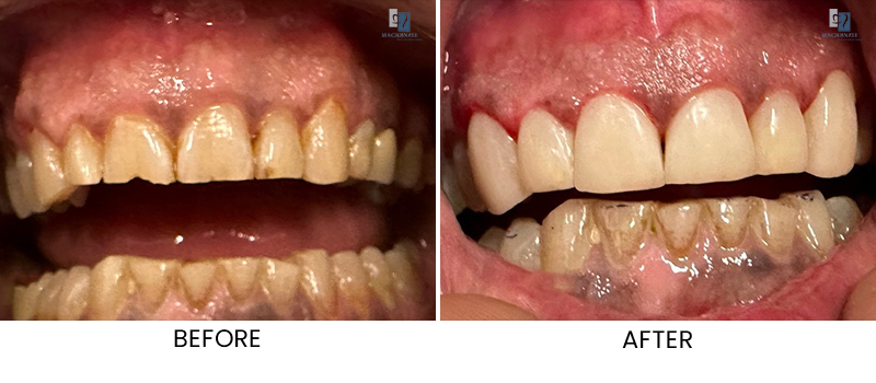 Composite veneer before and after