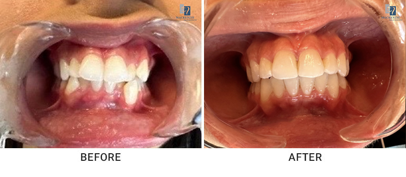 Invisalign before and after