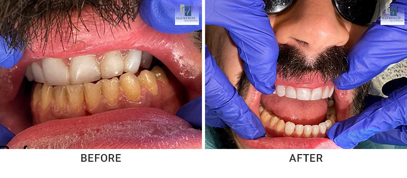 Composite veneers before and after