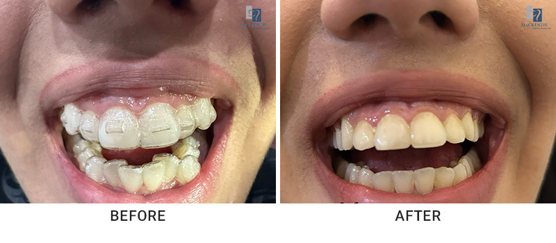 Invisalign before and after