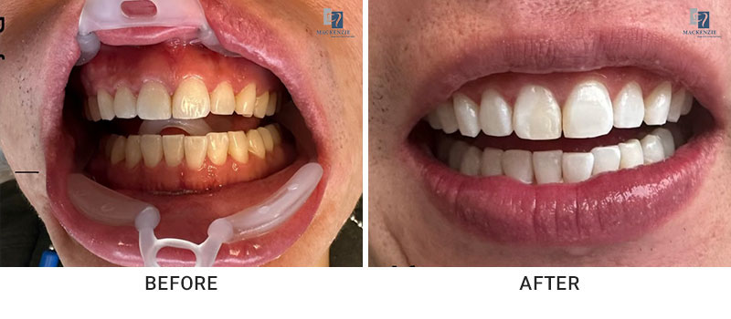 Office whitening before and after