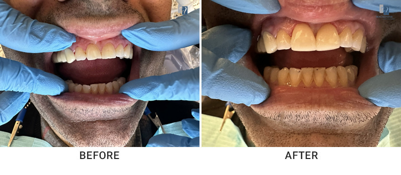Composite filling before and after
