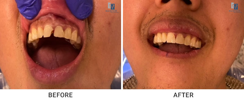 Composite filling before and after