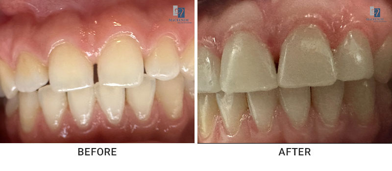 Composite veneers before and after