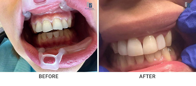 Composite veneers before and after