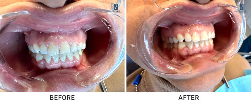 Composite veneers before and after