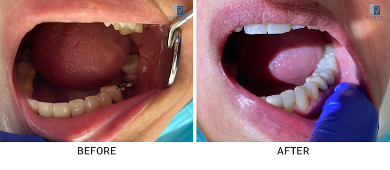 Dental implants before and after