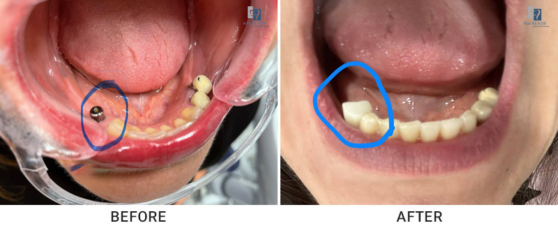 Dental implants before and after