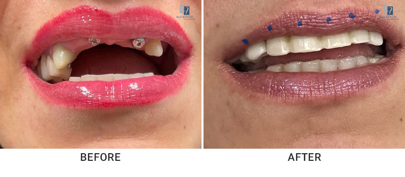 Dental implants before and after