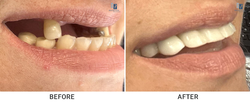 Dental implants before and after