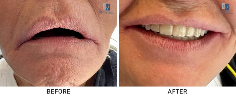 Dentures before and after