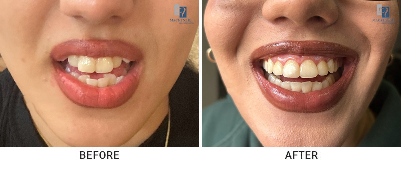 Invisalign before and after