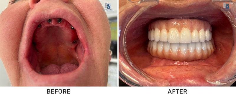 Whole mouth implants before and after